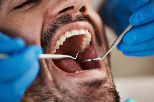 Best Emergency Dental Extractions in Energy, IL